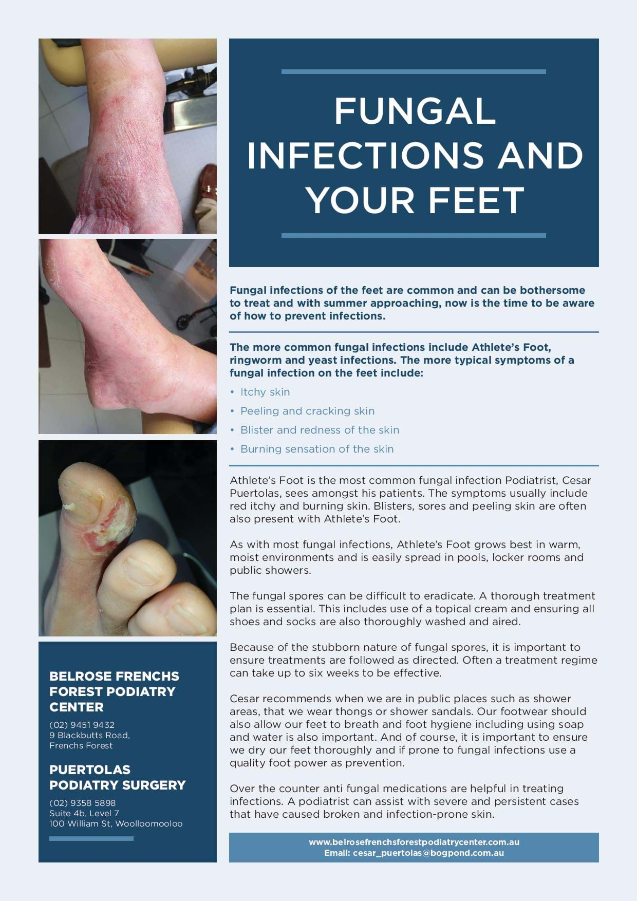 Fungal Infections and Your Feet